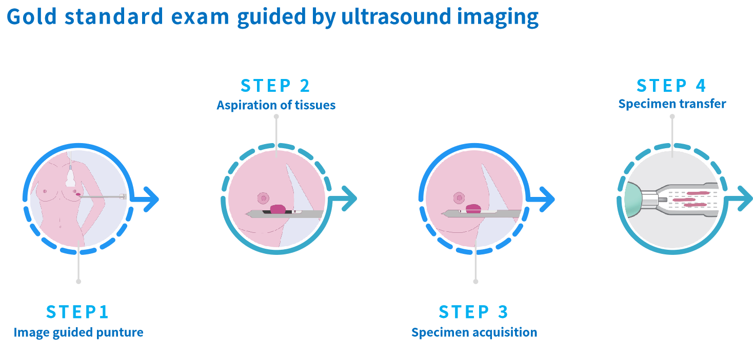 VABB procedure